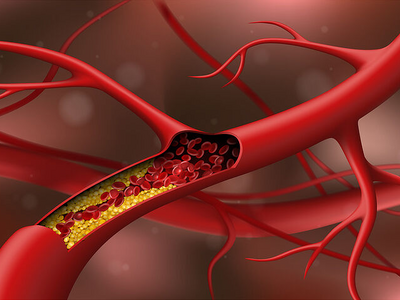 Αλλαγές στην αντιμετώπιση της χοληστερίν...