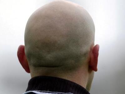 Έλληνας γιατρός θεραπεύει τη φαλάκρα!