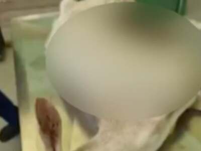 Κρέστενα: Δεν τα κατάφερε η ακρωτηριασμέ...