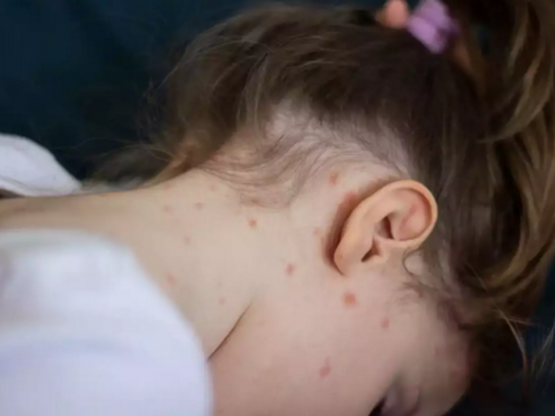 ΕΟΔΥ: Κρούσματα ιλαράς σε 30 χώρες της Ευρώπης 