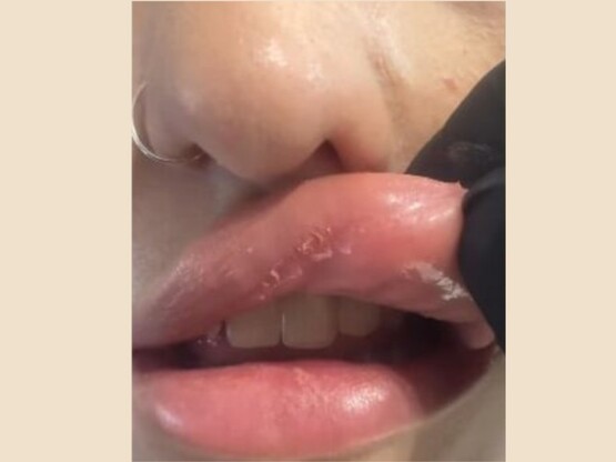 Έβαλε υαλουρονικό σε… νυχάδικο και παραμ...